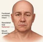 Difference Between Bell's Palsy And Stroke Diagnosis Signs