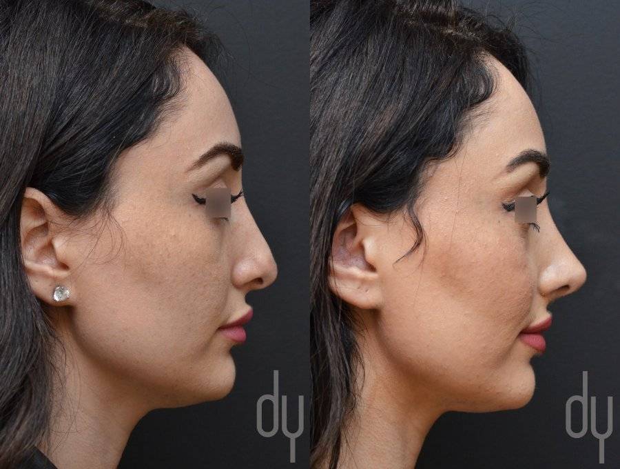AN-Revision-Rhinoplasty-Right-Profile-View.jpg