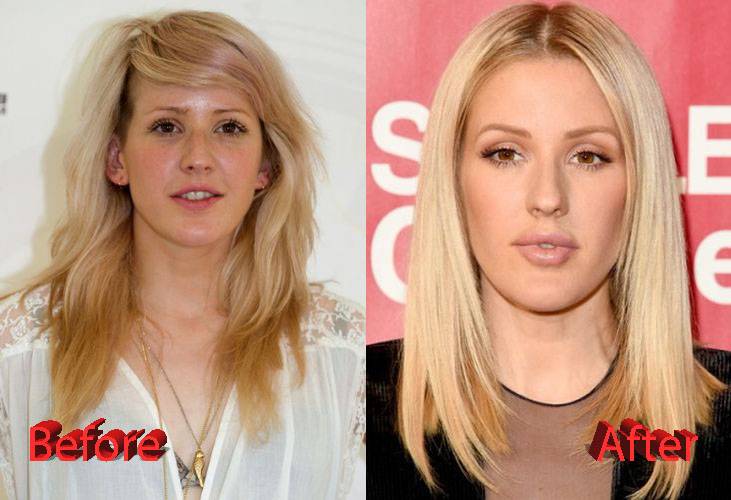 Ellie-Goulding-Plastic-Surgery-Before-and-After2.jpg
