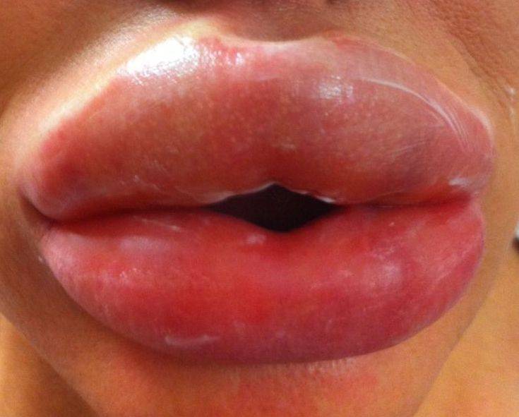 lip-fillers-gone-wrong-1.jpg