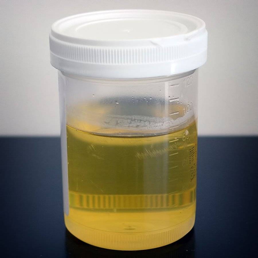 Urine_sample.jpeg